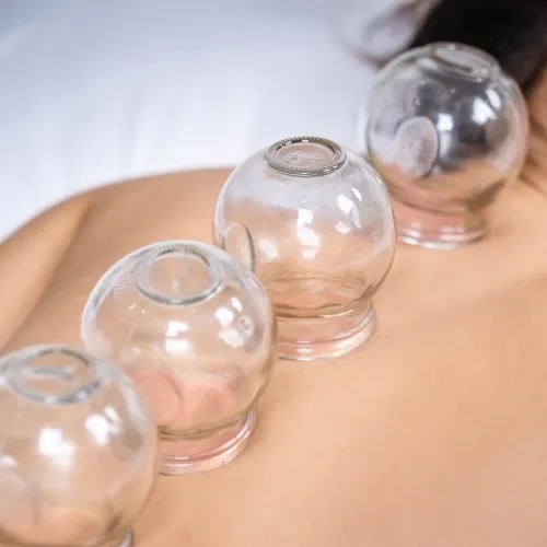 Cupping Therapy In Ottawa